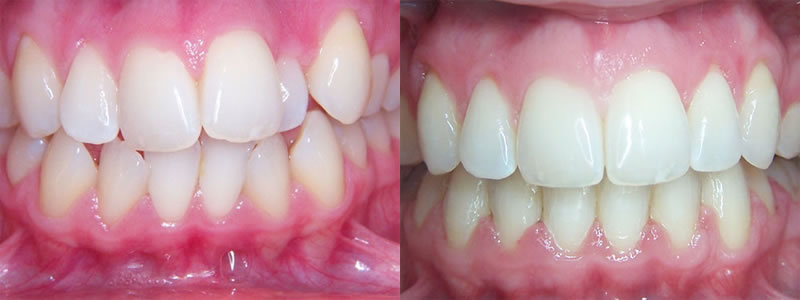 Invisalign® before and after