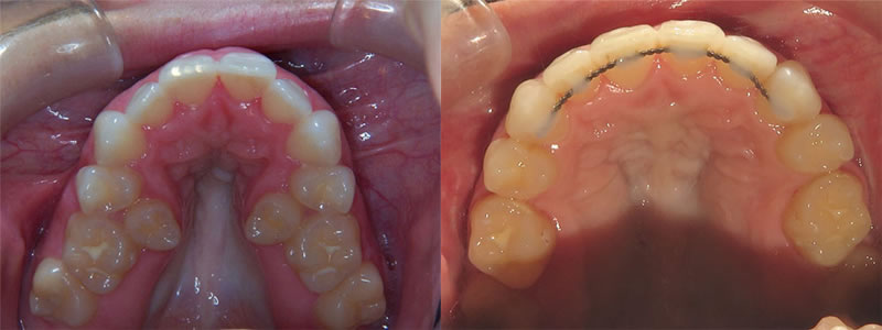 Braces with extraction
