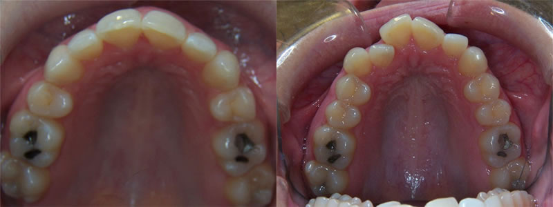 Invisalign® before and after