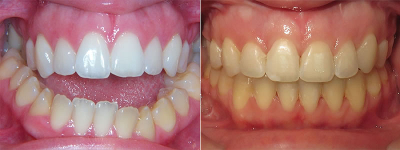 Braces with jaw surgery